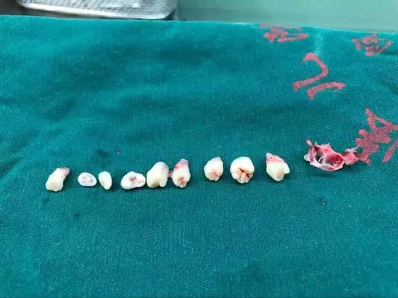 Lekarze wydobyli zęby z mózgu dziecka