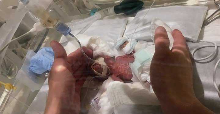 Tak wyglądał najmniejszy noworodek na świecie. Ważył mniej niż kostka masła