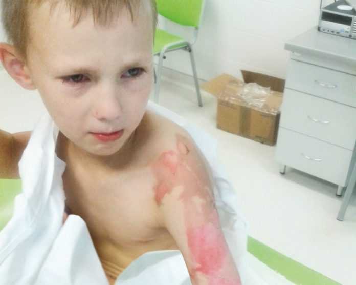 7-letni Jurek Polakowski ciężko poparzony w kawiarni. Nikt nie czuje się winny