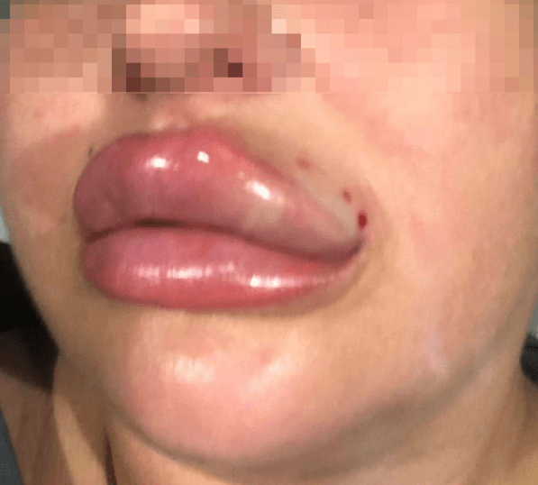 Poznań: Kosmetyczka miała jej powiększyć usta. Zabieg skończył się walką o życie