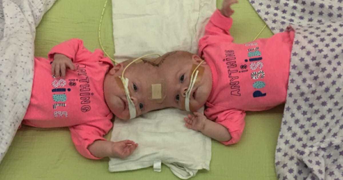 Zoperowano bliźniaczki syjamskie, aby dać im szansę na życie – dziś dziewczynki wyglądają promiennie