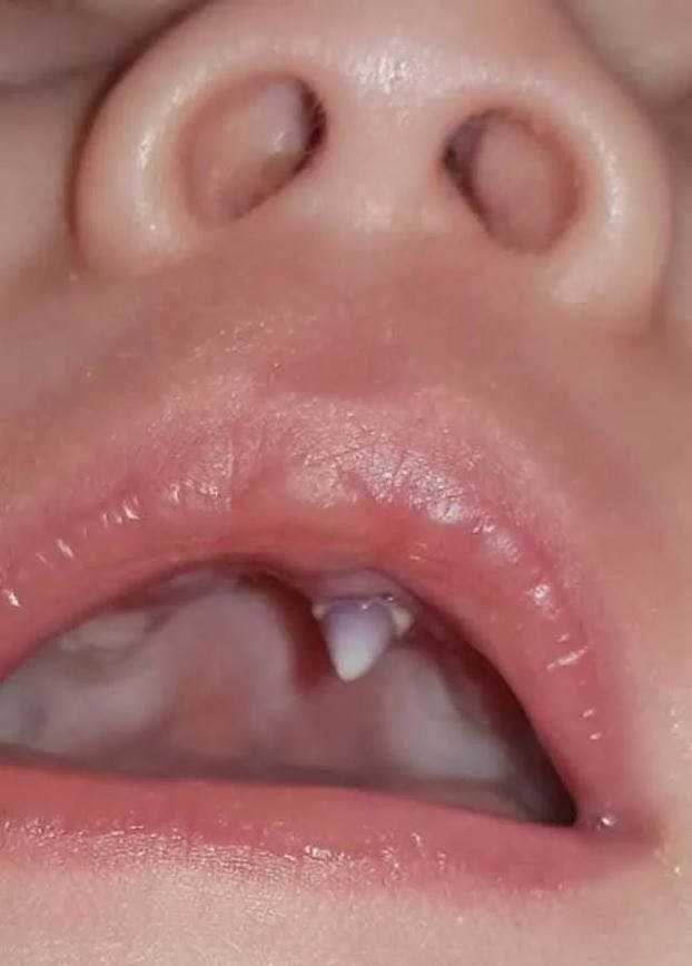 W ustach niemowlaka dostrzegła ząb. Lekarze nie potrafili wytłumaczyć tego przypadku