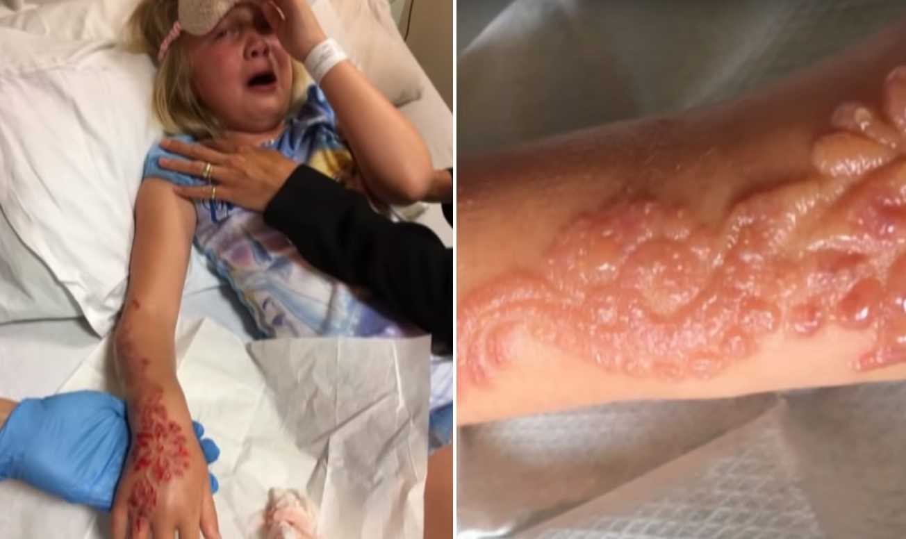 Siedmioletnia dziewczynka ma dotkliwie poparzoną rękę po tym jak zrobiła sobie tymczasowy tatuaż