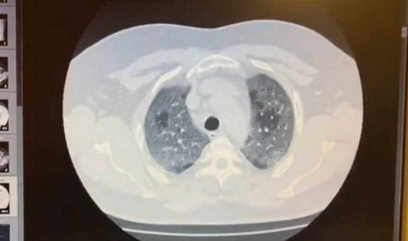 Lekarz Filip Płużański: Niezaszczepionemu choremu zostało 5 procent płuc do oddychania