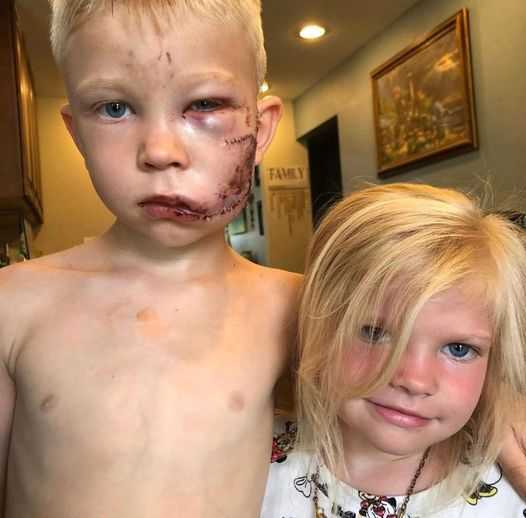 7-latek mówi, że jest „dumny ze swojej blizny” po tym, jak zasłonił swoją siostrę przed atakiem rozjuszonego psa